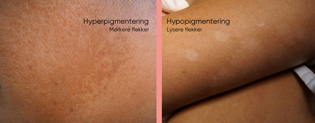 Pigmentering av huden, hyperpigmentering og hypopigmentering