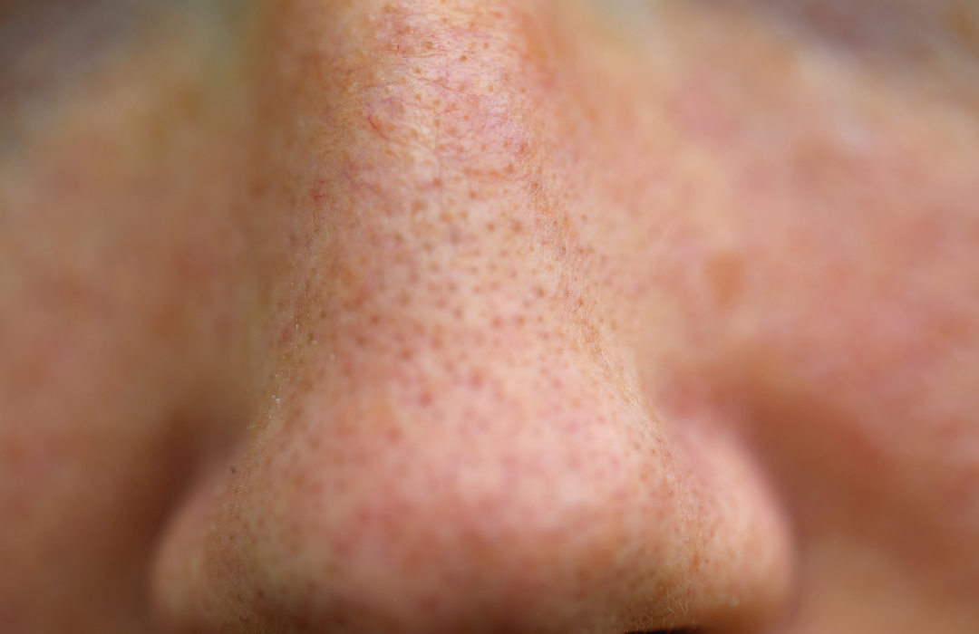 store porer og sorte prikker hudpleie som hjelper